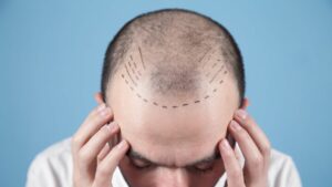 hairloss-man-transplantation-istanbul-clinic-marking-forehead-stirnglatze-cultureandcream-blogpost