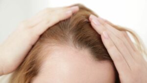 hairloss-woman-forehead-transplantation-cultureandcream-blogpost