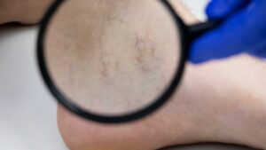 besenreiser-spider-veins-lupe-magnifying-legs-cultureandcream-blogpost