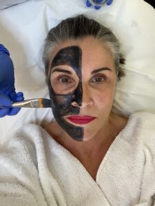 peel-peeling-carbon-laser-beauty-treatment-cultureandcream-blogpost