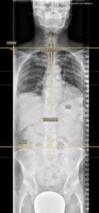 brustkorb-chest-after-treatment-scan-cultureandcream-blogpsot