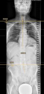 brustkorb-scan-roentgen-before-treatment-cultureandcream-blogpost